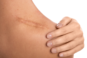 Scars, abrasions Scars, abrasions