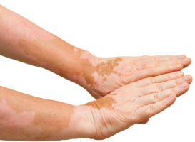 Cutaneous mycoses, fungi