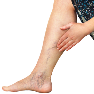 Varicose veins Varicose veins