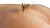 Insect bites and stings