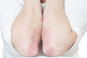 Psoriasi