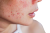 Acne
