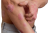 Eczema, atopy