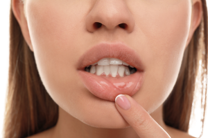 Aphtha and mouth care