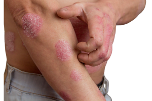 Eczema, atopy