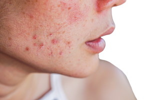 Acne