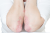 Psoriasis